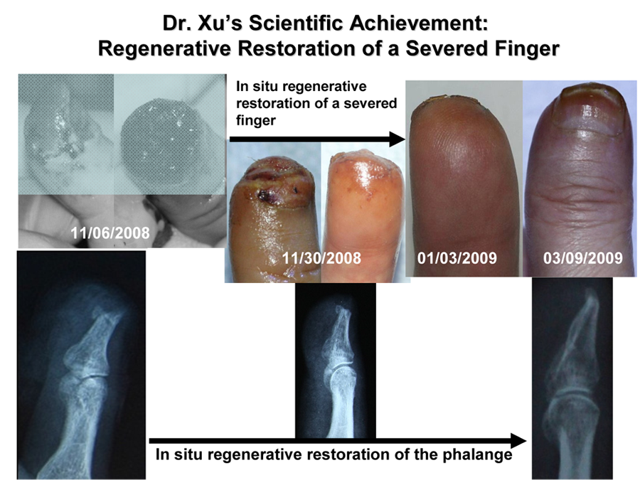 Regenerative Restoration of a Severed Finger